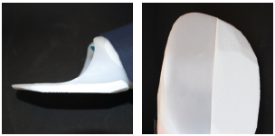 Pictured valgus forefoot posting