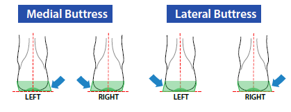 diagram of the medial and lateral buttress options