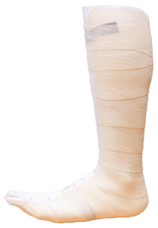 pictured a fiberglass cast
