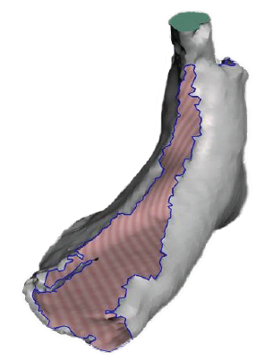An example of a scan with holes too large and unable to be corrected.