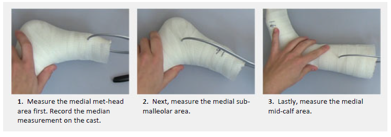 Pictured are the three locations to measure cast thickness at the met heads, near the heel, and up the calf.