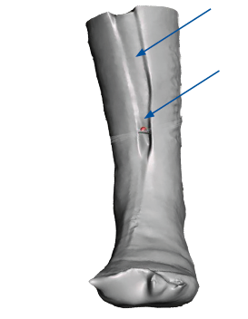 Scan shows a long chasm-like seam added to it, confusion proportions and volume.