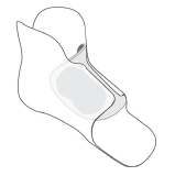 Diagram of glued in instep pad