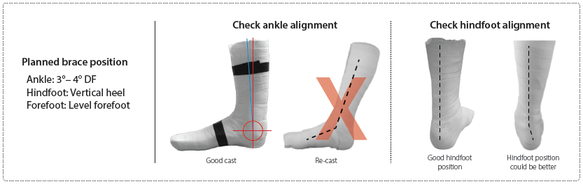 Visuals that compare a cast with good alignment to a cast that should be recasted for better alignment