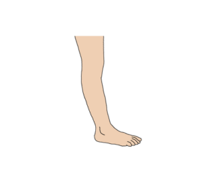 Lack of knee flexion or slight hyperextension
