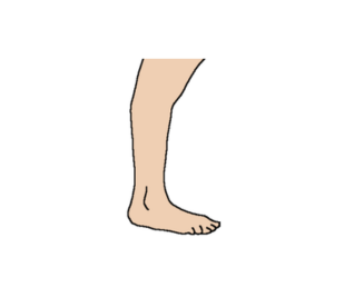 Significant knee hyperextension 