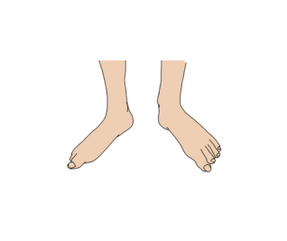 Foot shows moderate pronation or supination 