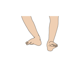 Foot shows strong pronation or supination 