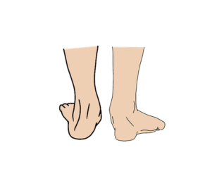  Extreme inversion/eversion