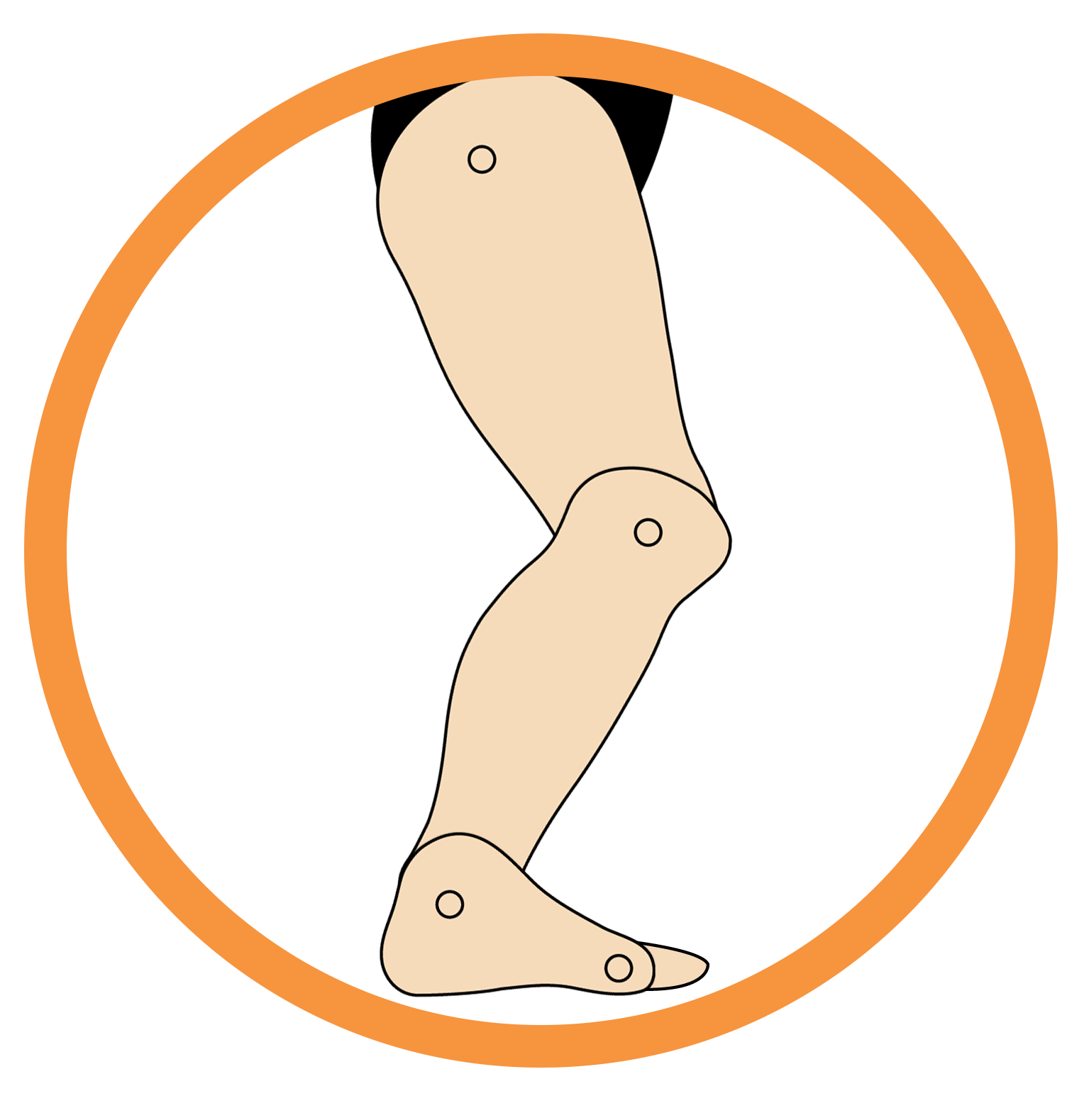 Excess Dorsiflexion
