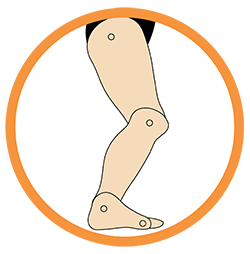 Excess Dorsiflexion