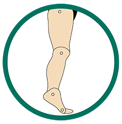 This image showcases the structure of the foot that is suffering from Excess Plantarflexion