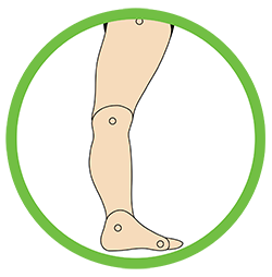 This image showcases the structure of the foot that is suffering from Knee Hyperextension