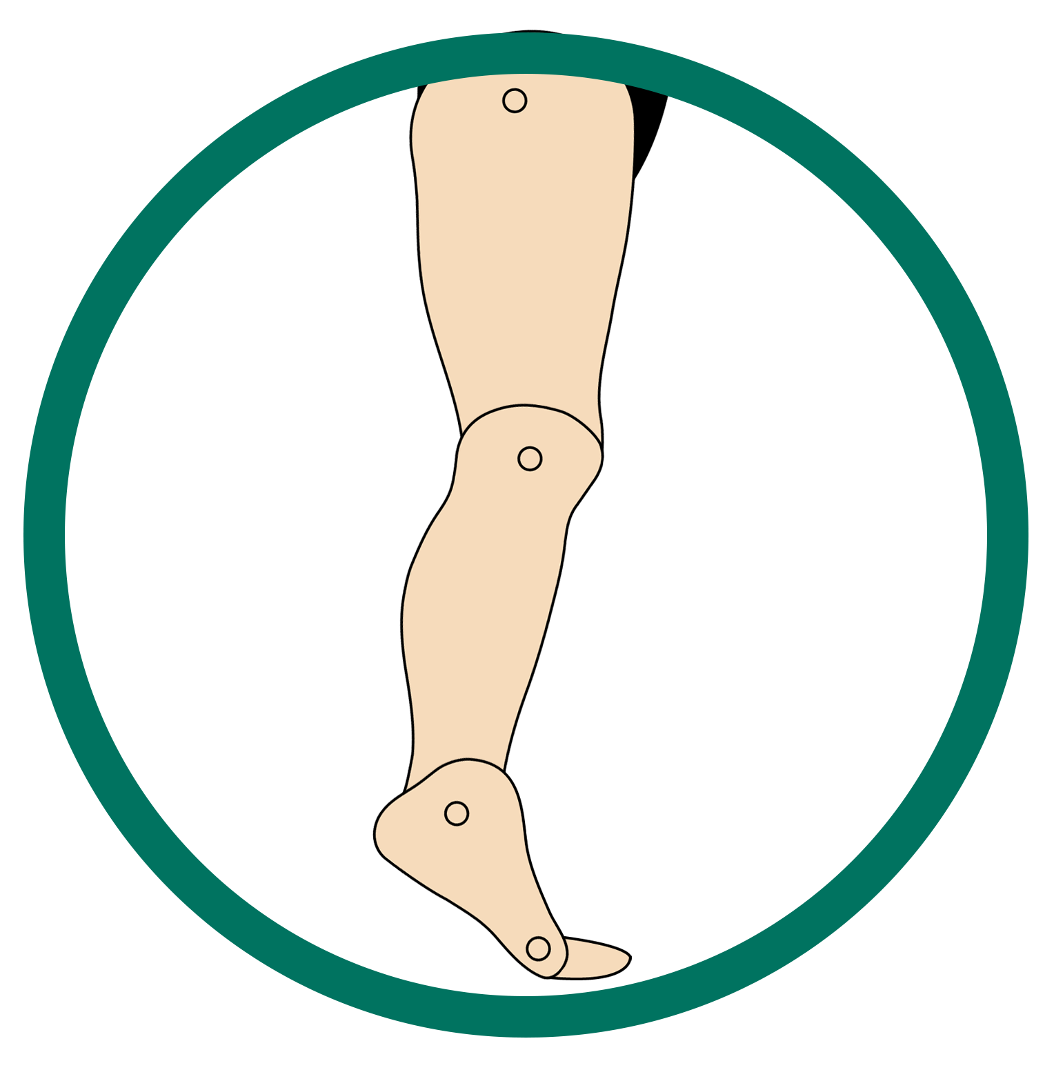 This image showcases the structure of the foot that is suffering from Excess Plantarflexion