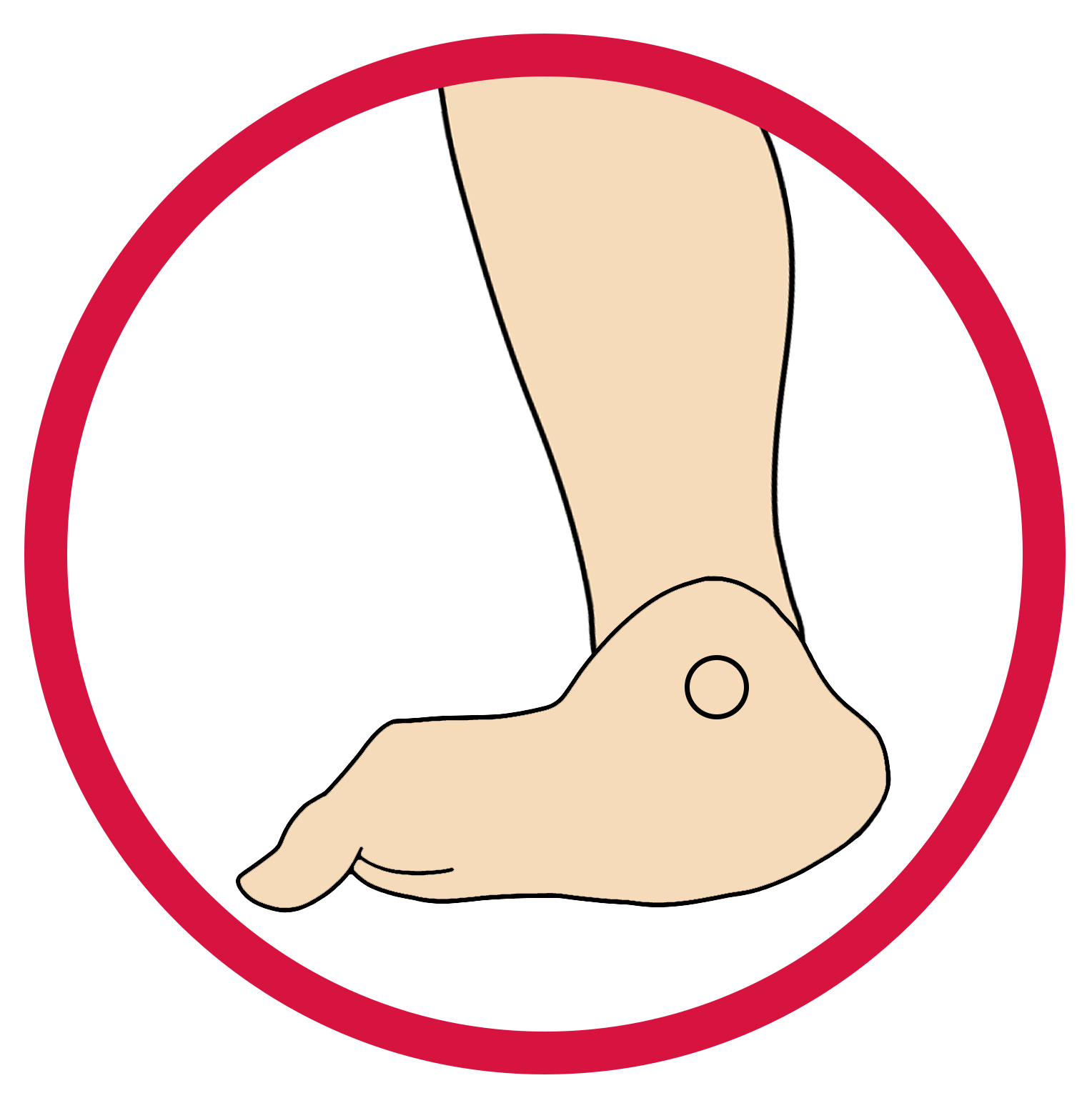 This image showcases the structure of the foot that is suffering from Positioning. 