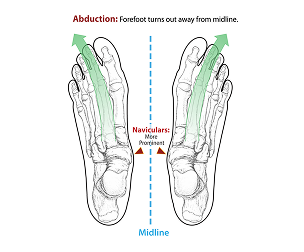 Forefoot abduction