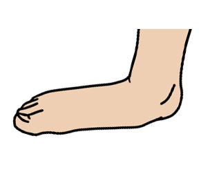 This image shows a pronated foot