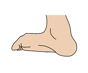 This image shows a foot with supination
