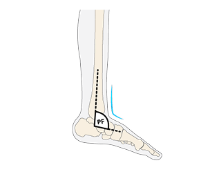 Drop Foot