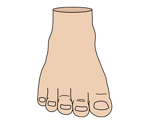 Neutral Forefoot