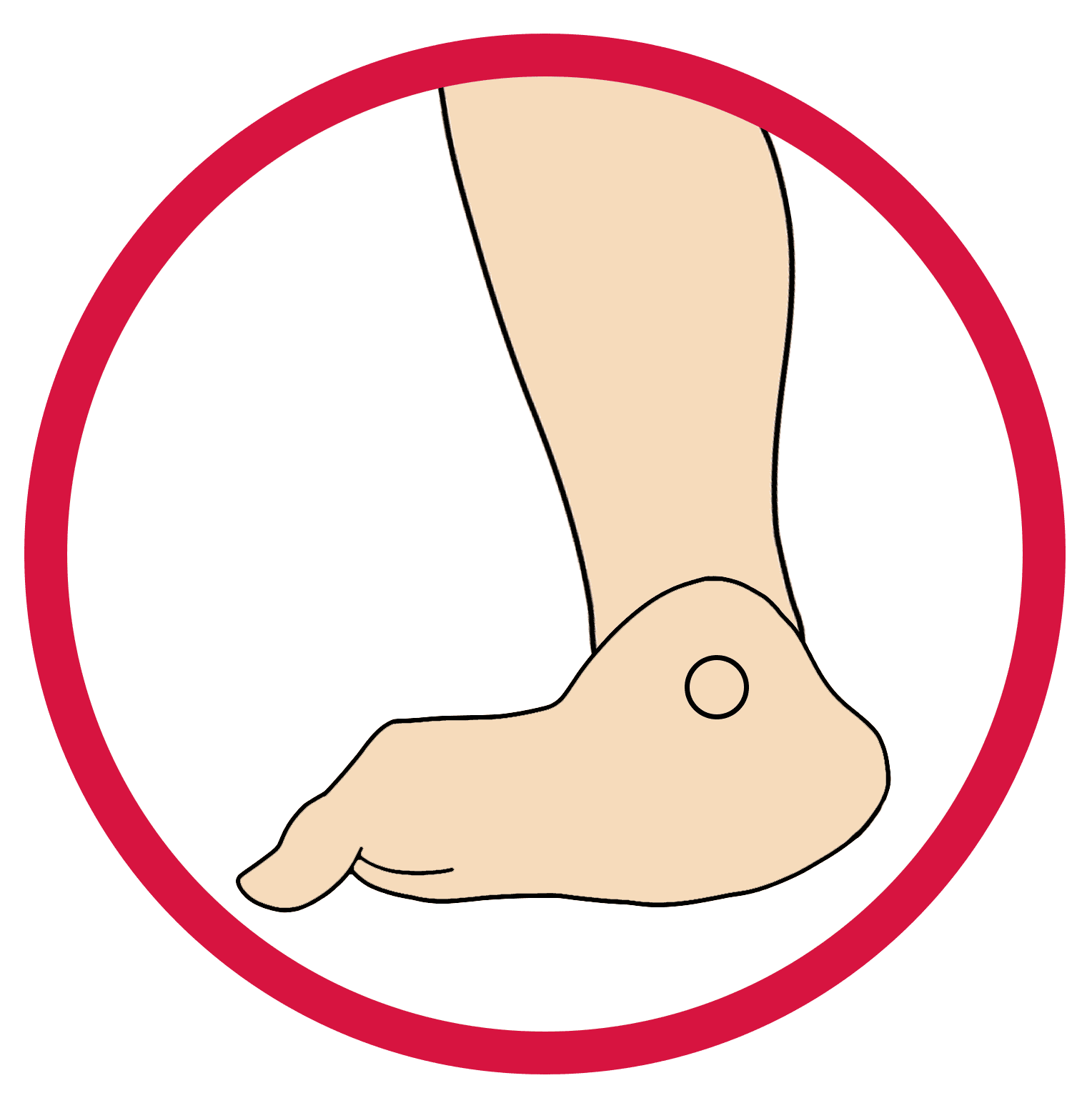 This image showcases the structure of the foot that is suffering from Positioning. 