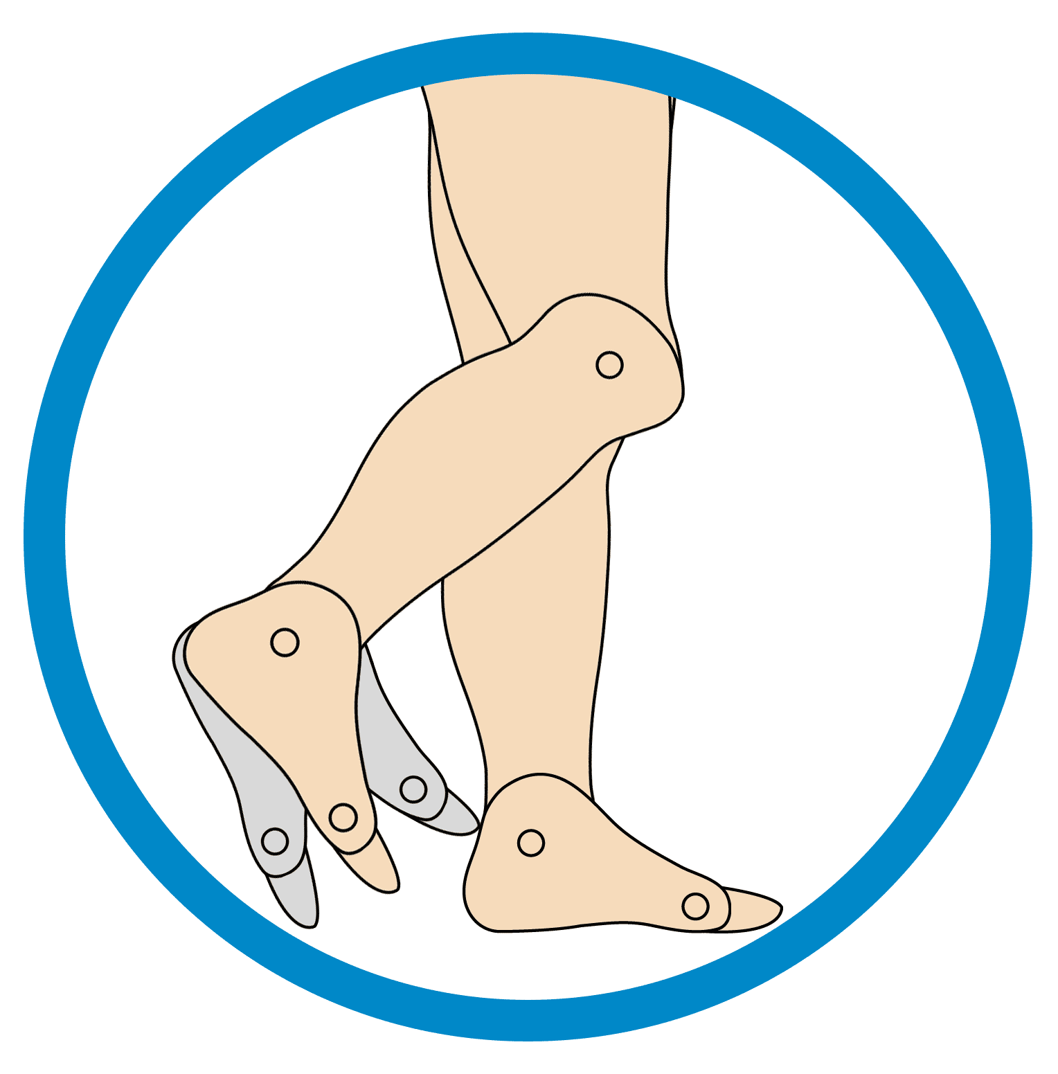 This image showcases the structure of the foot that is suffering from Swing Phase Inconsistency