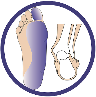 This image showcases the structure of the foot that is suffering from High tone pronation/Supination