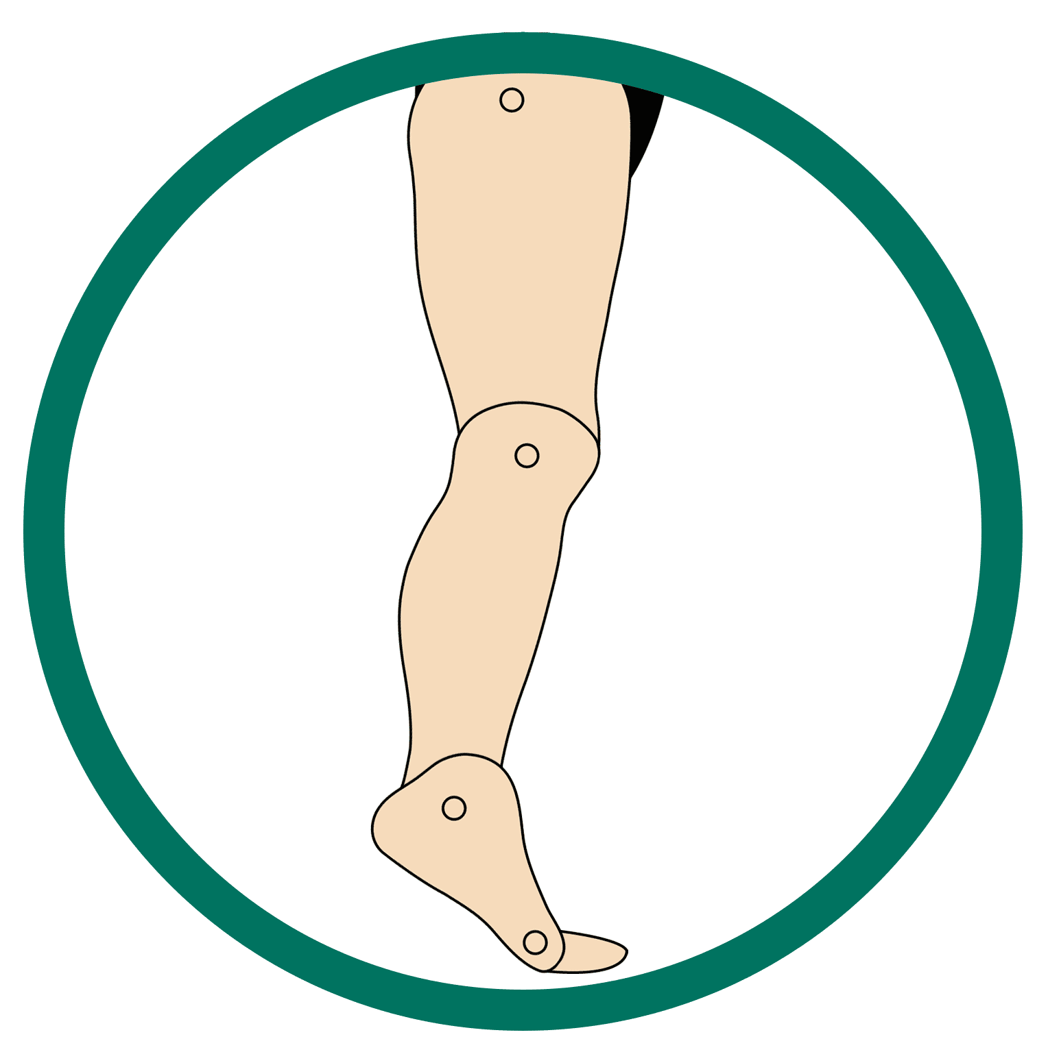 This image showcases the structure of the foot that is suffering from Excess Plantarflexion