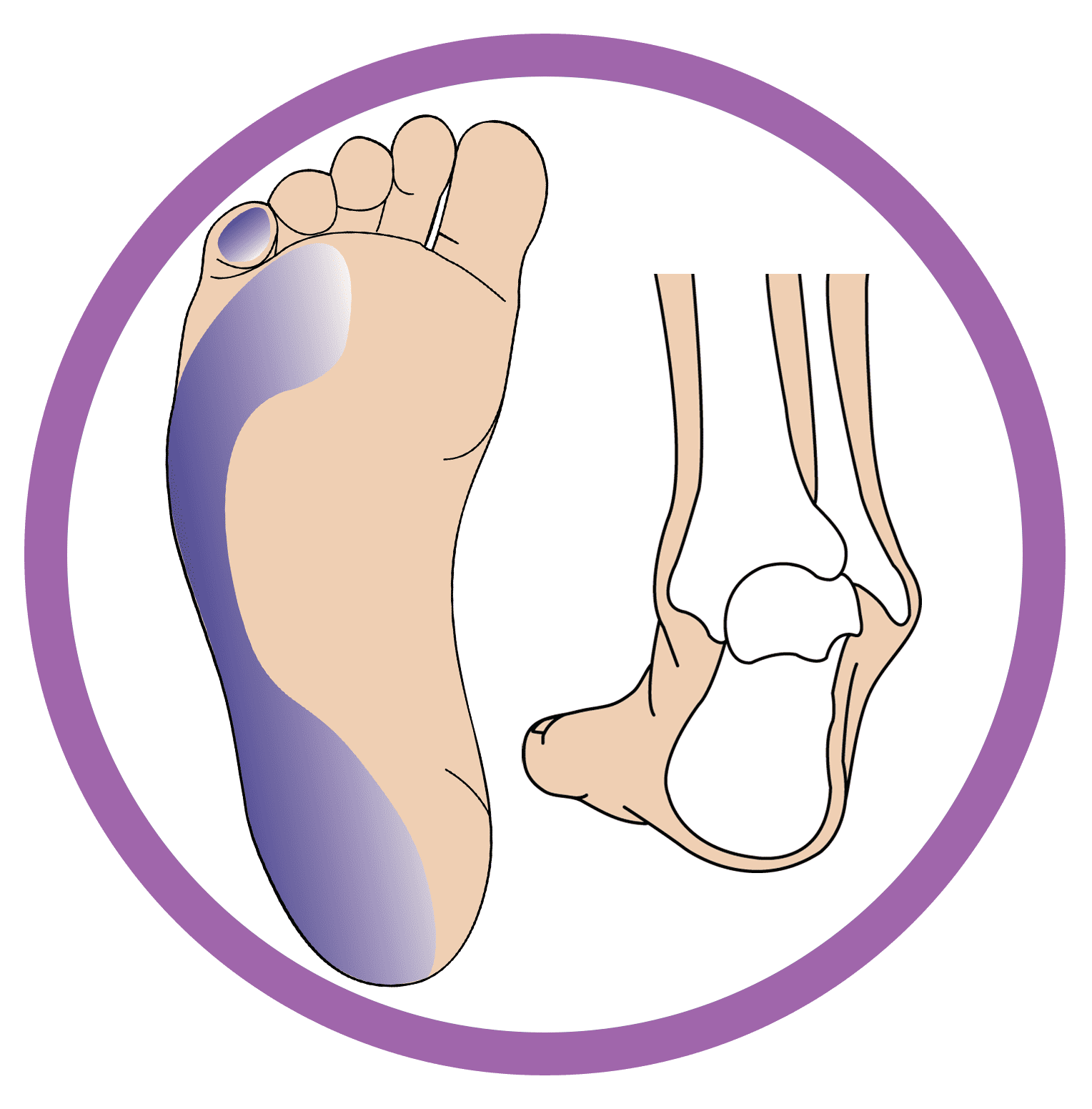 This image showcases the structure of the foot that is suffering from High tone pronation/Supination