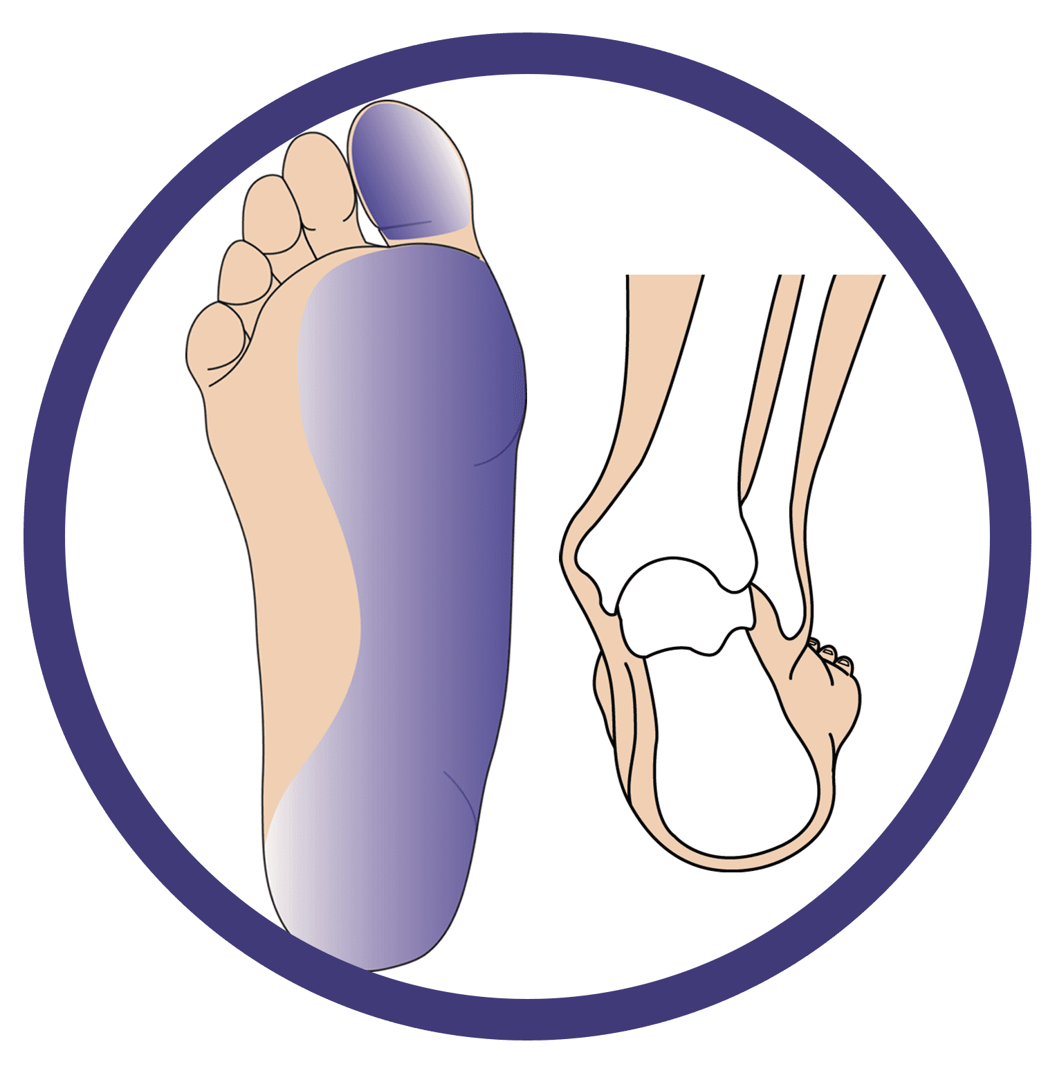This image showcases the structure of the foot that is suffering from Low Tone Pronation